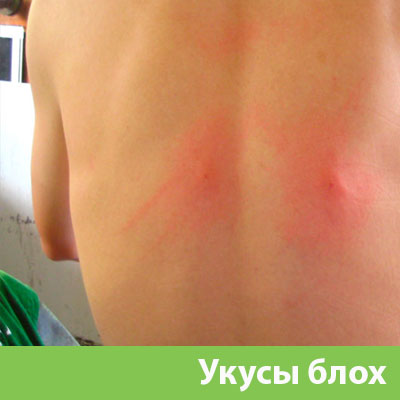 Укусы блох в Благовещенске