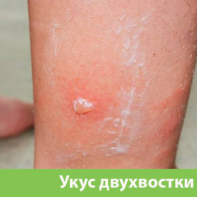Укус двухвостки в Благовещенске