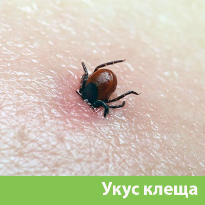 Укус клеща в Благовещенске