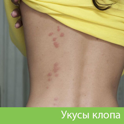 Профессиональное уничтожение клопов в Благовещенске